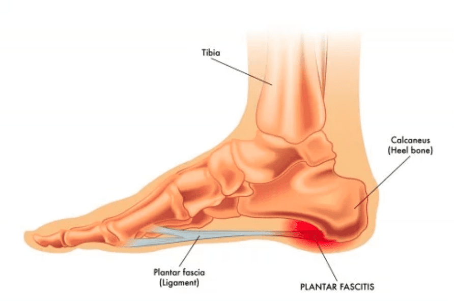 Plantar Fasciitis